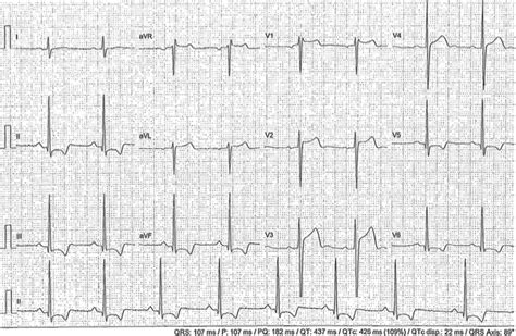 A new consensus document on electrocardiographic .